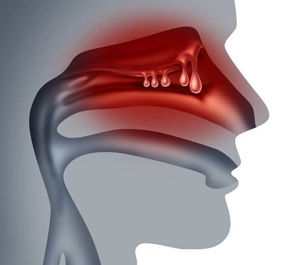Polypen in der Nase (Nasenolypen; Illustration)