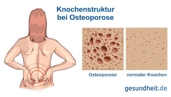 Struktur bei normalen Knochen und bei Osteoporose (Infografik)