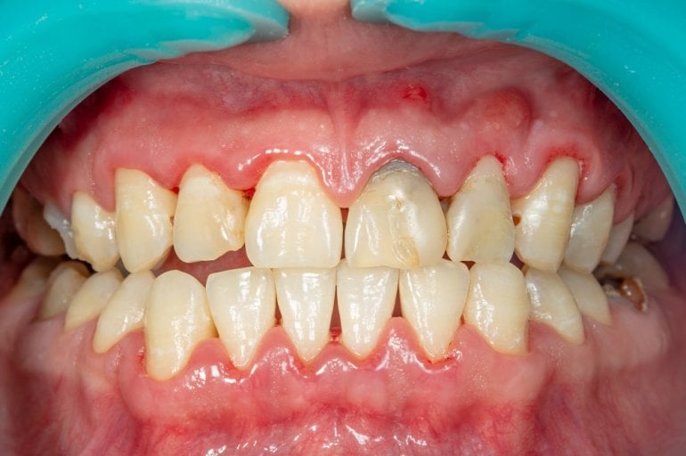 Zähne und Zahnfleisch bei Parodontitis
