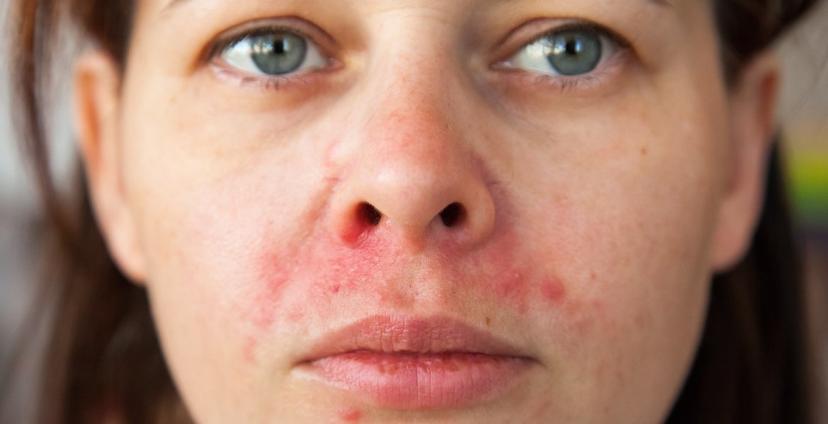 Frau mit rotem Ausschlag durch periorale Dermatitis um den Mund