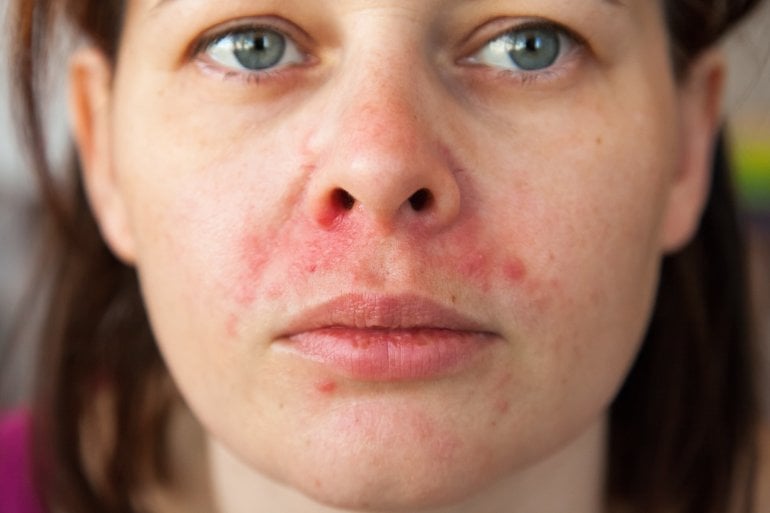 Frau mit rotem Ausschlag durch periorale Dermatitis um den Mund