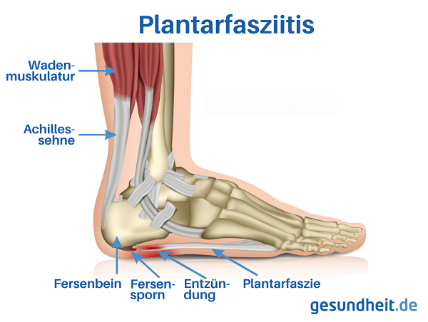 Plantarfasziitis (Infografik)