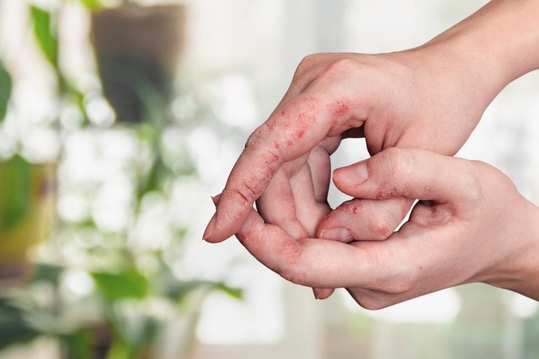 Hände mit Anzeichen von Psoriasis-Arthritis