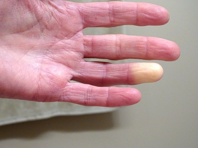 Weißer Finger mit Raynaud-Syndrom