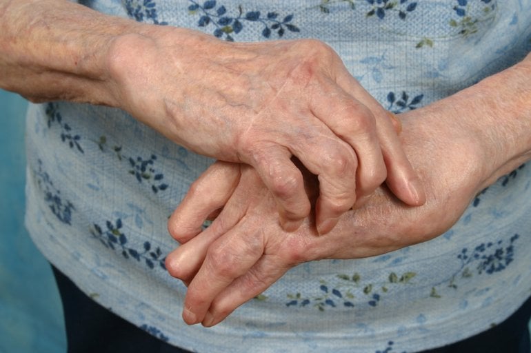 Hände einer Frau mit rheumatoider Arthritis