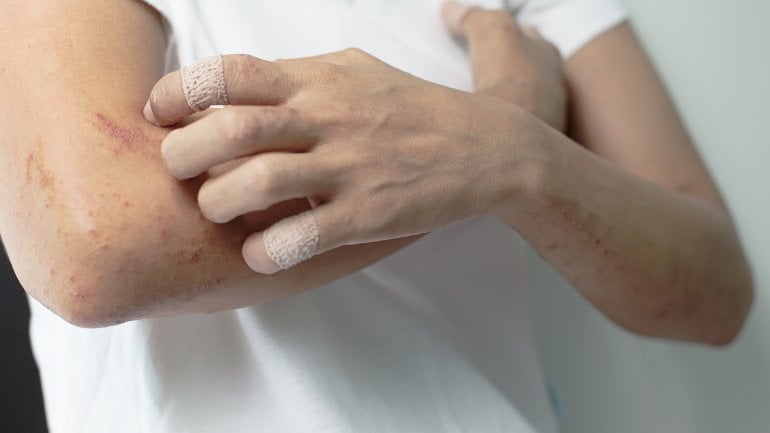 Krätze: Symptome, Ursache und Behandlung der Hautkrankheit - Wissen