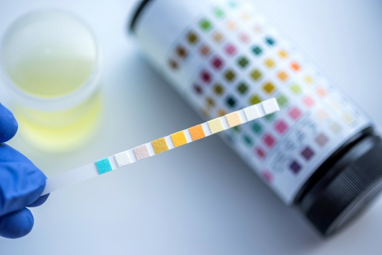 Urinuntersuchung mit Harn-Teststreifen