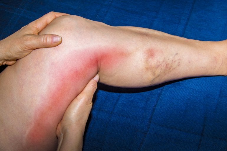Bein mit Venenentzündung (Phlebitis)