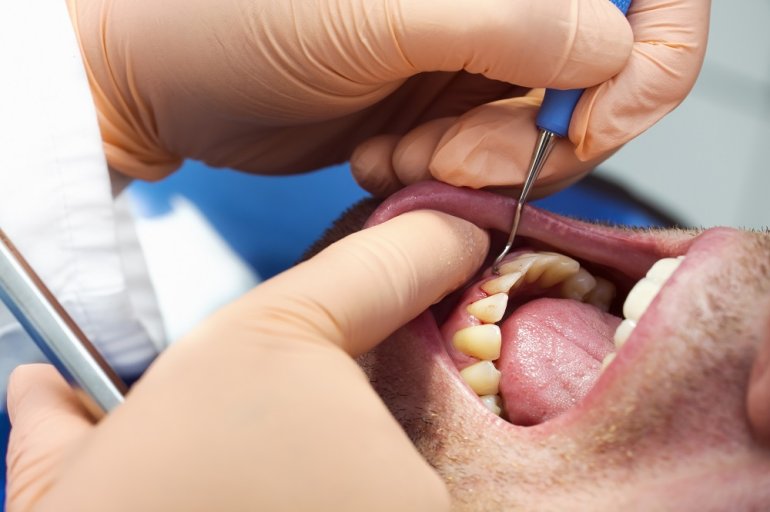 Zahnarzt untersucht Zahnfleischentzündung