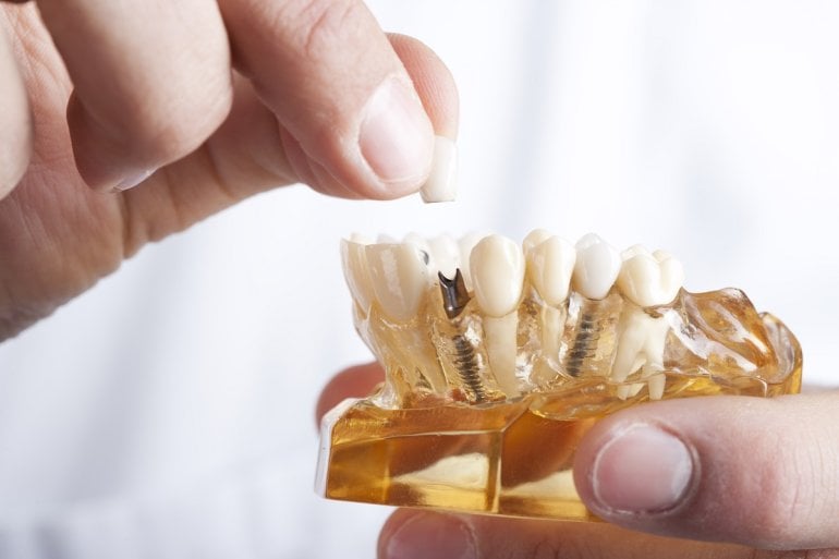 Zahnarzt zeigt Modell von Zähnen mit Zahnimplantat