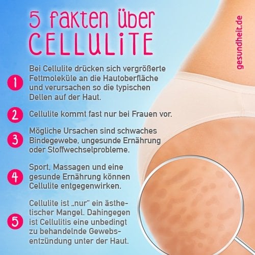 5 Fakten über Cellulite (Infografik)