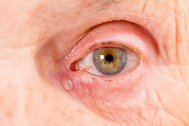 Tränende Augen (Epiphora) Tränende Augen (Epiphora)