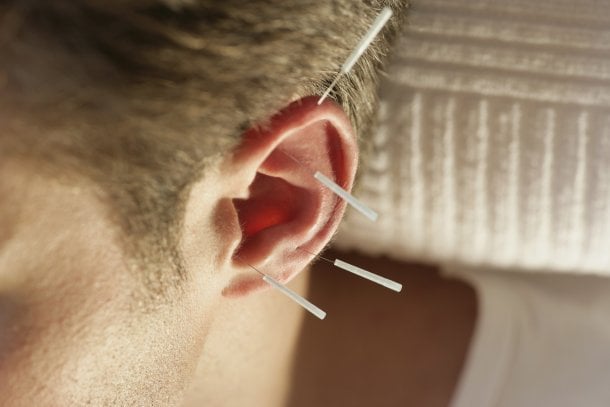 Tinnitus mit Akupunktur behandeln Tinnitus mit Akupunktur behandeln