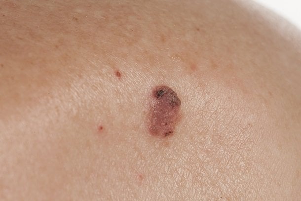 Hautkrebs: Plattenepithelkarzinom Hautkrebs: Plattenepithelkarzinom
