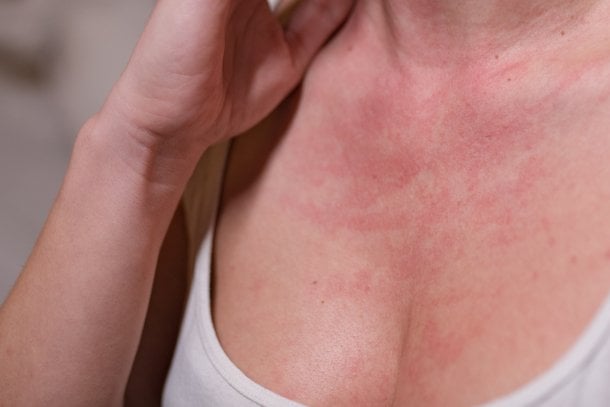 Hautrötung als mögliches Symptom Hautrötung als mögliches Symptom