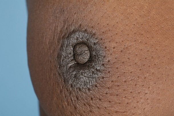 Einziehen der Brustwarze als sichtbares Warnsignal Einziehen der Brustwarze als sichtbares Warnsignal
