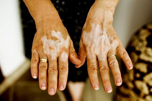 Vitiligo (Weißfleckenkrankheit) Vitiligo (Weißfleckenkrankheit)