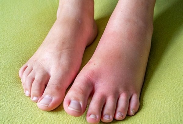 Entzündung nach Mückenstich Entzündung nach Mückenstich
