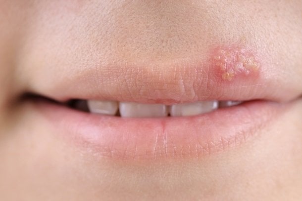 Herpes im Mund Herpes im Mund