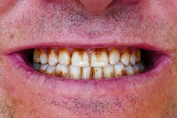 Fluorose auf den Zähnen