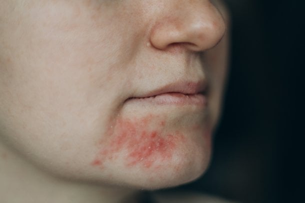 Mundrose (Periorale Dermatitis) Mundrose (Periorale Dermatitis)
