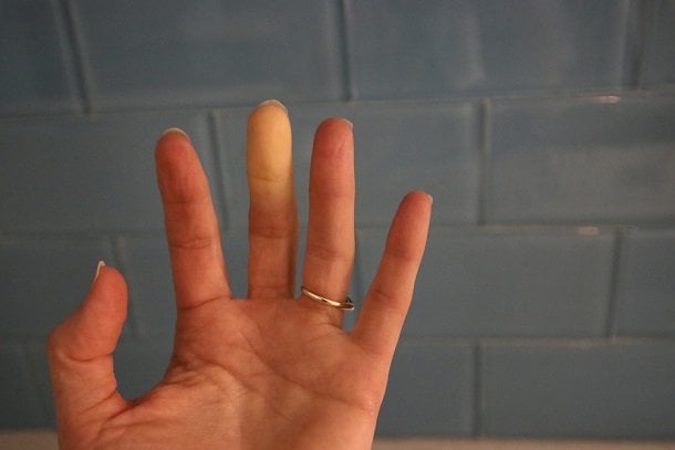 Weiße oder blaue Fingernägel und -kuppen Weiße oder blaue Fingernägel und -kuppen