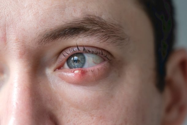 Pickel am Auge Pickel am Auge