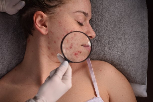 Face Mapping: Bedeutung von Pickeln im Gesicht Face Mapping: Bedeutung von Pickeln im Gesicht
