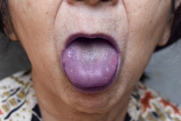 Zyanose durch Sauerstoffmangel bei COPD Zyanose durch Sauerstoffmangel bei COPD