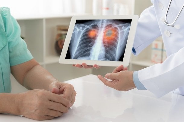 Bronchialkarzinom Bronchialkarzinom