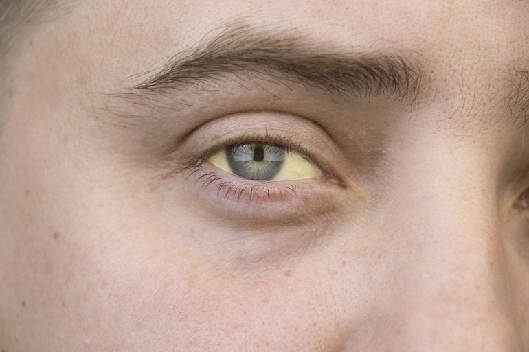 Gelb gefärbtes Auge eines Mannes mit Morbus Meulengracht